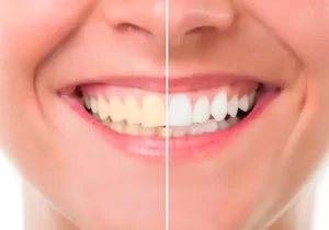 Clareamento dental de graça – Saiba como fazer!