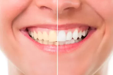 Clareamento dental de graça – Saiba como fazer!